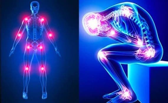 Fibromyalgie